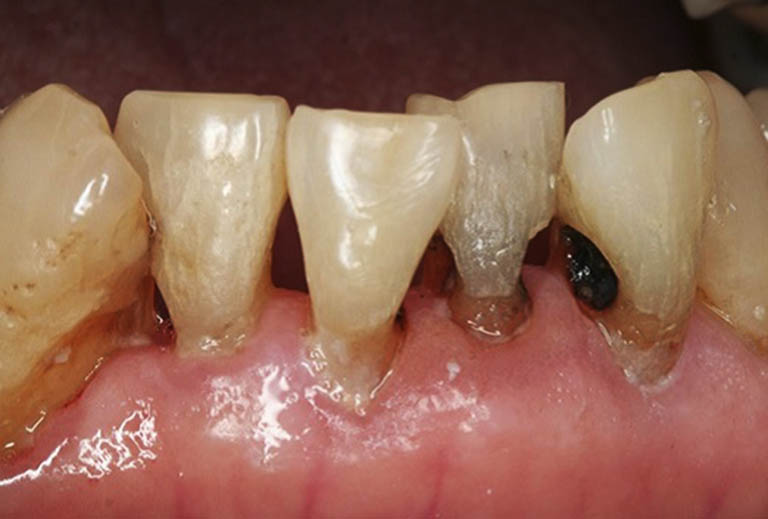 Nguyên nhân dẫn đến sâu chân răng
