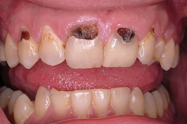 Sâu chân răng: Nguyên nhân, cách điều trị phục hồi hiệu quả