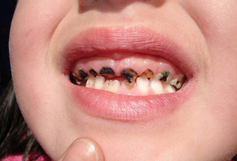 Dấu hiệu nhận biết sâu răng ở trẻ em