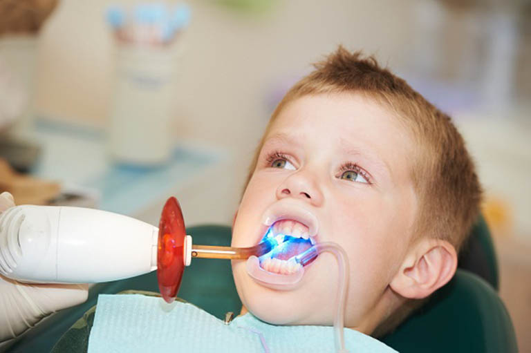 Trám răng chữa sâu răng ở trẻ em