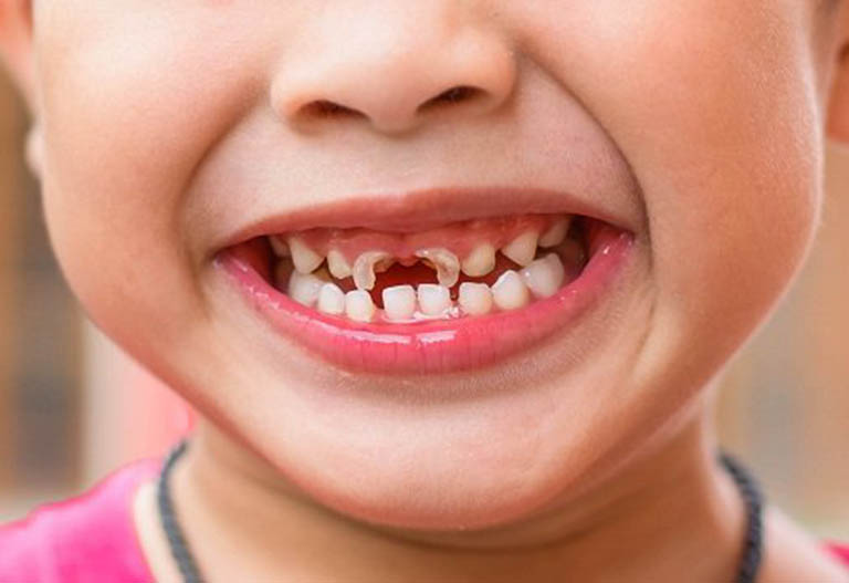 Sâu răng ở trẻ em: Nguyên nhân, cách điều trị và phòng ngừa