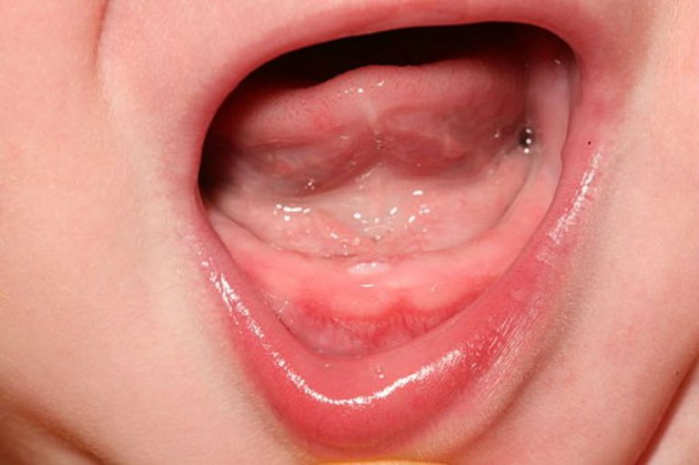 Viêm lợi ở trẻ nhỏ tiến triển theo 2 giai đoạn và rất dễ dẫn đến viêm nha chu.