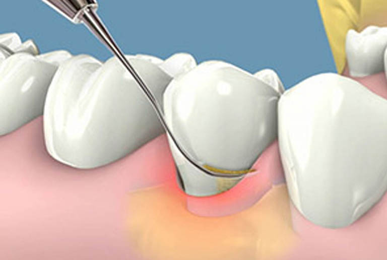 Phương pháp điều trị sưng lợi răng hàm tại nha khoa 