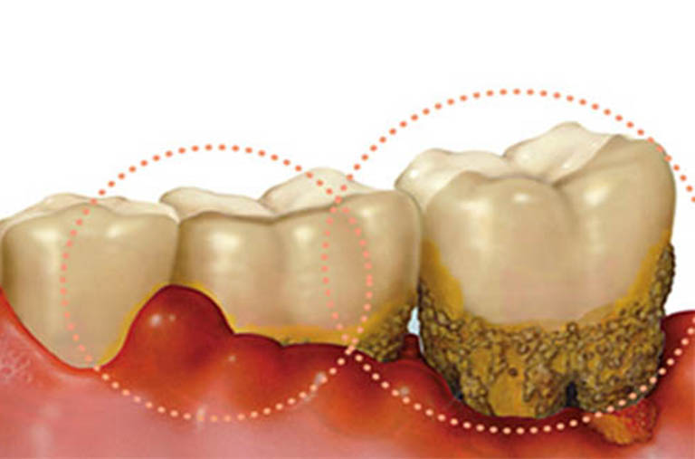Sưng nướu răng có mủ - Thuốc và cách điều trị hiệu quả