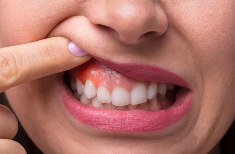Dấu hiệu nhận biết sưng nướu răng có mủ