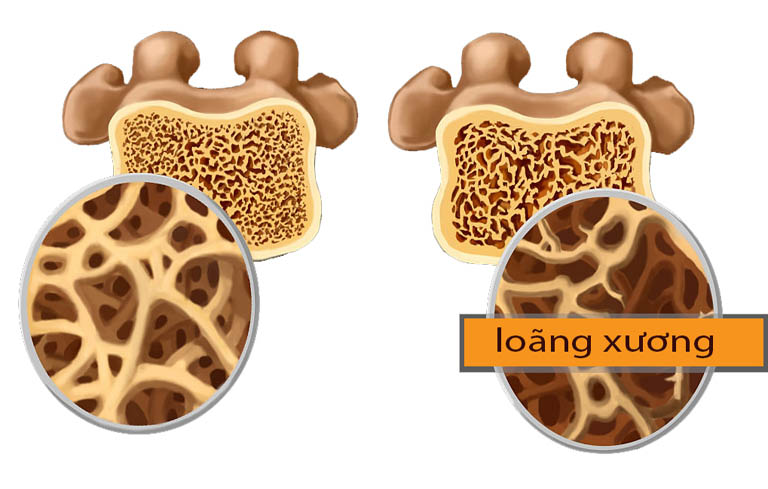 Tắt kinh không được điều trị kịp thời có thể gây loãng xương Tắt kinh không được điều trị kịp thời có thể gây loãng xương