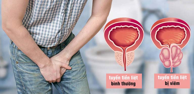 Bệnh viêm tuyến tiền liệt không chỉ gây phiền toái cho cuộc sống nam giới mà còn gây ra nhiều biến chứng nguy hiểm