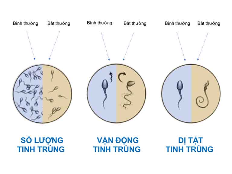 Những biến đổi bất thường của tinh trùng khi bị viêm tuyến tiền liệt 