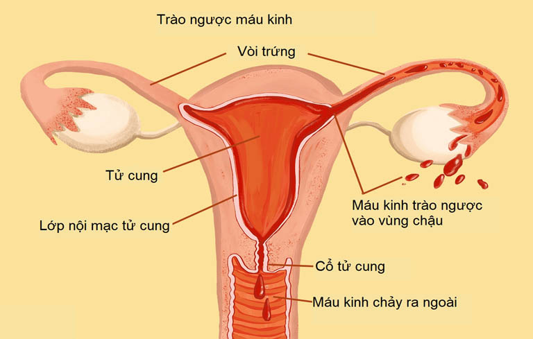 Trào ngược máu kinh là một trong những yếu tố gây ra bệnh