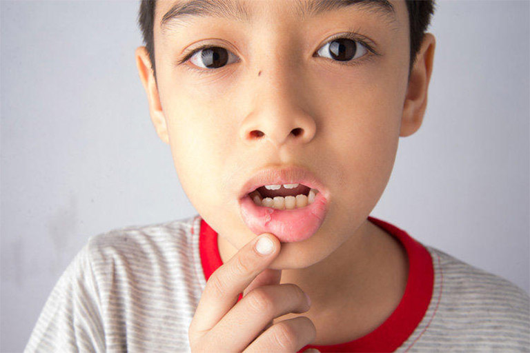 Trẻ em bị nhiệt miệng có nguy hiểm không? Điều trị nhiệt miệng cho trẻ như thế nào là an toàn?