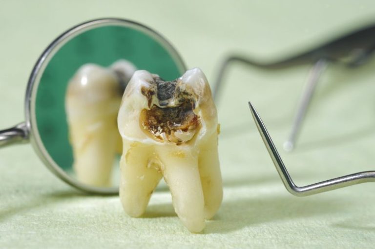 Răng cấm bị sâu có nhổ hay không tùy vào tình trạng sức khỏe của bạn và mức độ tổn thương răng.