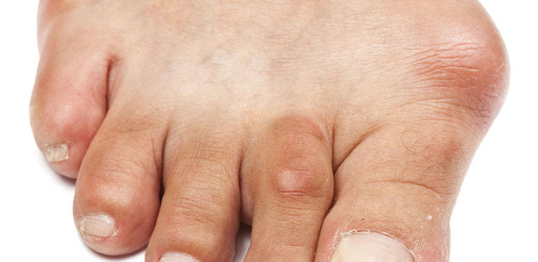 triệu chứng viêm bao hoạt dịch ngón chân cái