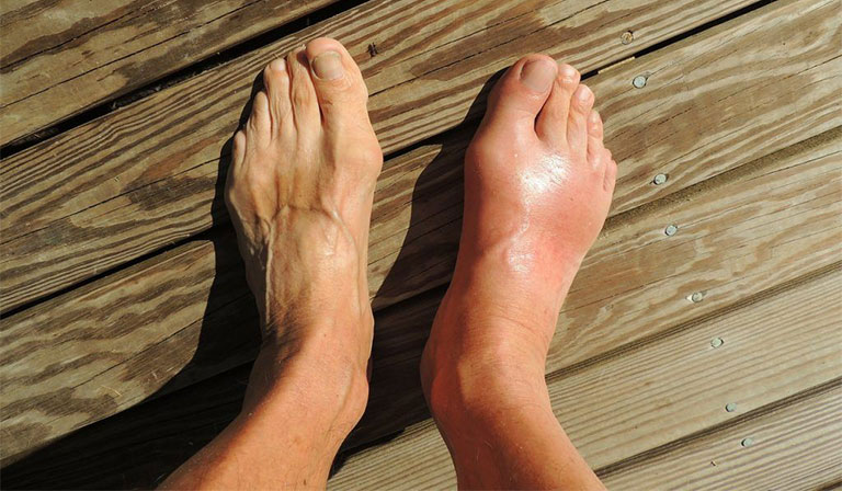 nguyên nhân gây viêm bao hoạt dịch ngón chân cái
