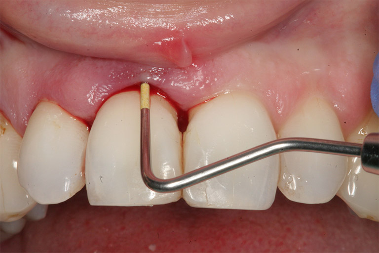 Bệnh viêm chân răng có mủ là một trong những bệnh răng miệng rất nguy hiểm