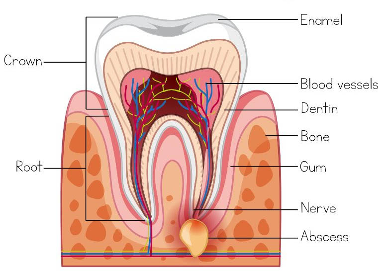 Viêm chân răng có mủ được hình thành là do sự nhiễm trùng ở phần mô nướu 