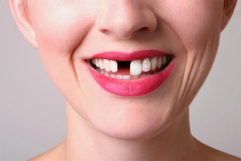 Mất răng là một trong những biến chứng nguy hiểm của bệnh viêm chân răng có mủ