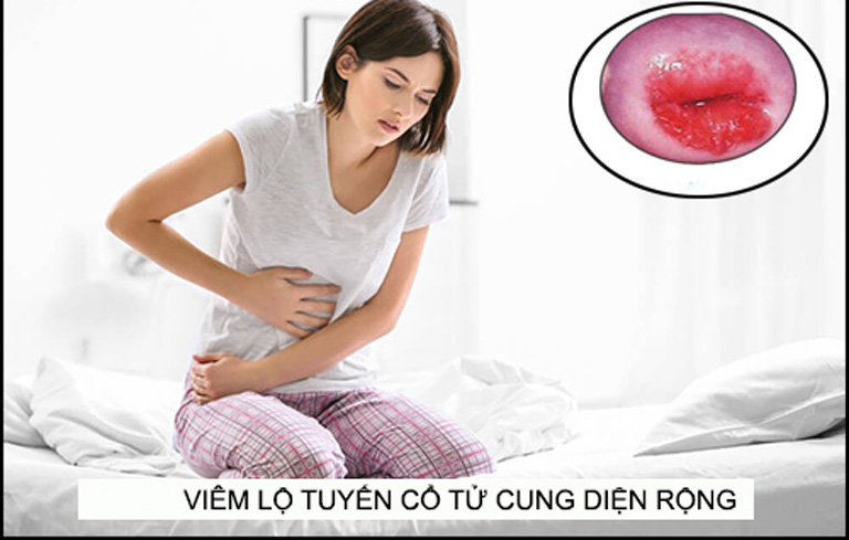 Viêm lộ tuyến cổ tử cung diện rộng