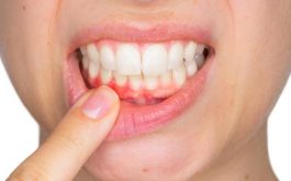 Bệnh viêm lợi chảy máu chân răng