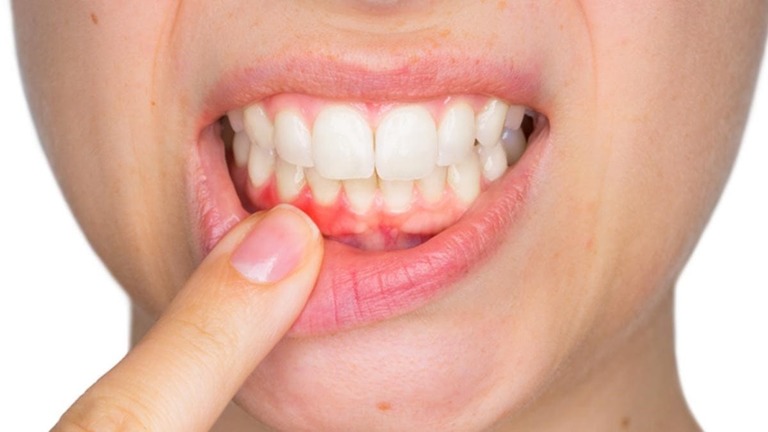 Viêm lợi chảy máu chân răng và cách điều trị hiệu quả