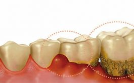 Viêm lợi rất nguy hiểm nếu không được điều trị sớm và đúng cách.