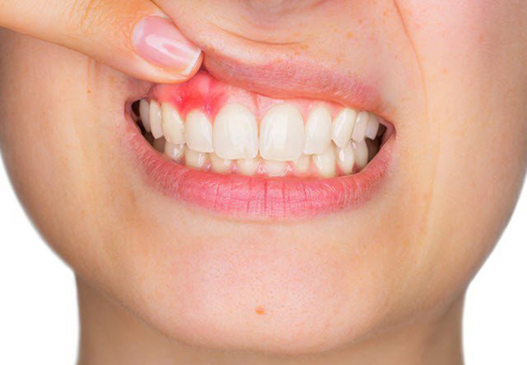 Chảy máu chân răng là triệu chứng thường gặp của bệnh viêm lợi