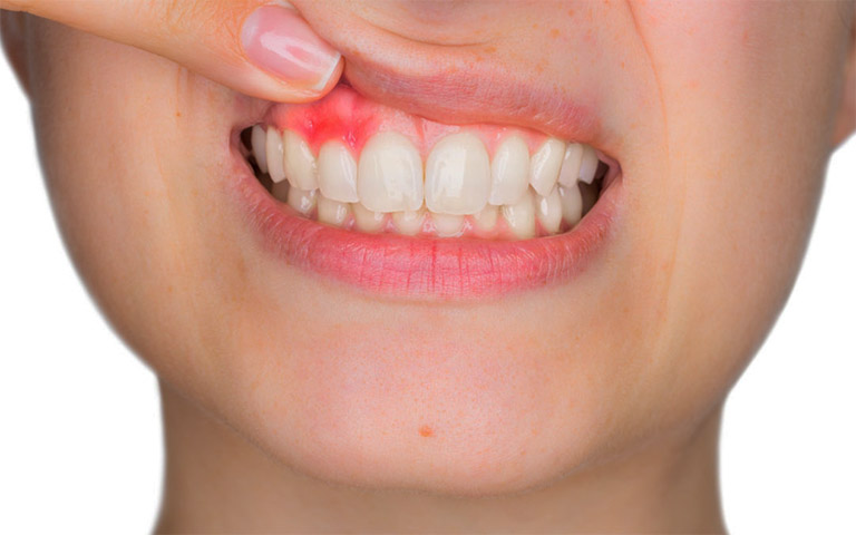 Tìm hiểu những thông tin về bệnh viêm nướu răng: Nguyên nhân, biểu hiện, cách điều trị và một số biện pháp phòng ngừa