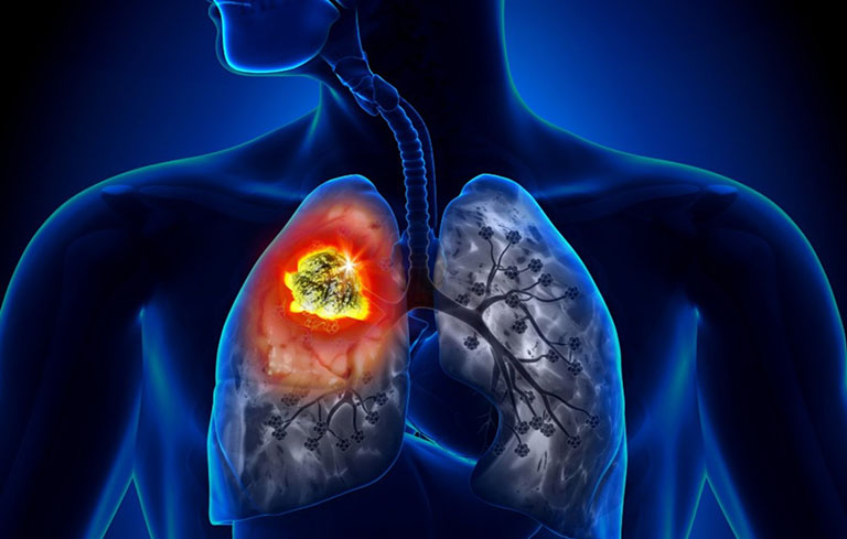 Viêm phổi có chữa được không