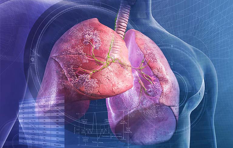 Viêm phổi điều trị bao lâu thì khỏi?