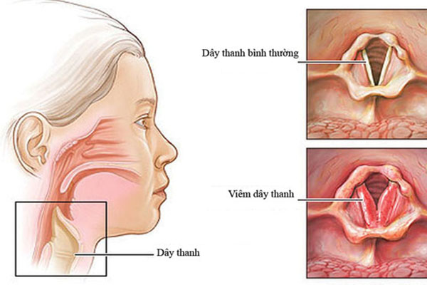 Viêm thanh quản có nguy hiểm không