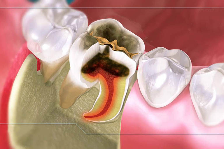 Viêm tủy răng có chữa được không? Có nguy hiểm không?