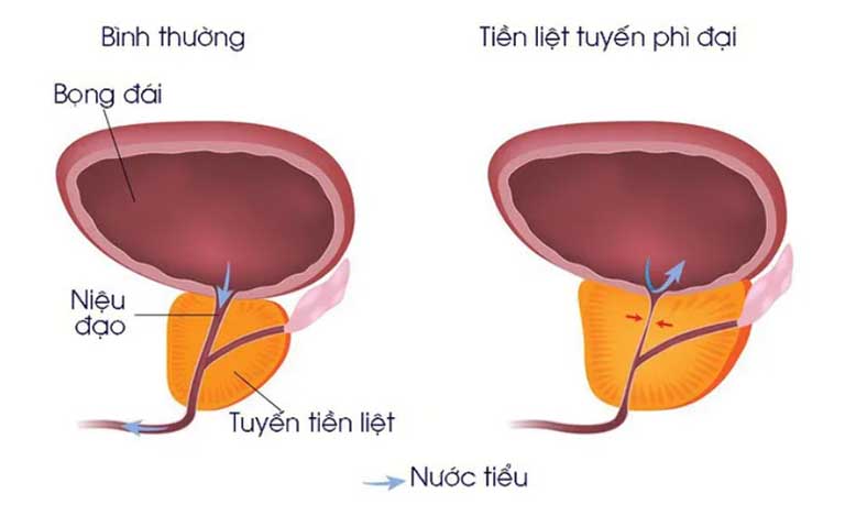 Tùy thuộc vào kích thước của tuyến tiền liệt mà các bác sĩ sẽ lựa chọn phương pháp điều trị bệnh thích hợp