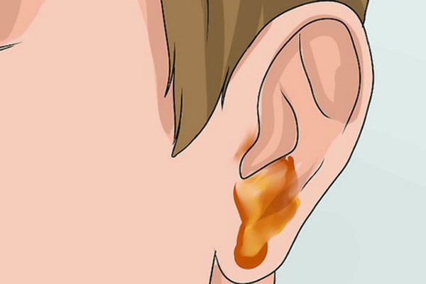 Viêm tai giữa ở trẻ em