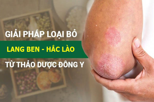 Phản hồi bài thuốc đặc trị lang ben - hắc lào
