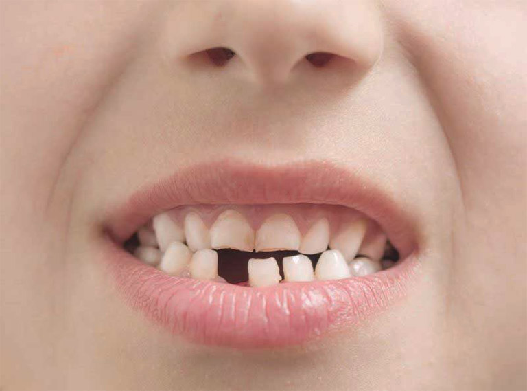 Mất răng là một trong số biến chứng nguy hiểm của tình trạng ê buốt răng, răng lung lay nếu không được tiến hành điều trị kịp thời