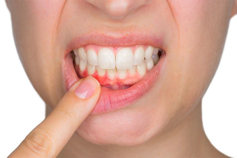 Viêm nướu cũng có thể là một trong những thủ phạm gây ra tình trạng răng bị ê buốt và lung lay