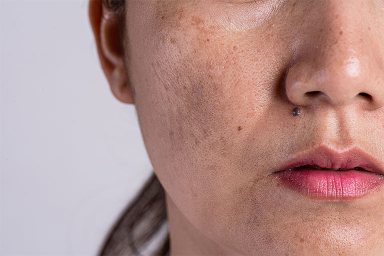 Những sản phẩm tế bào gốc trị nám da mặt được đánh giá cao