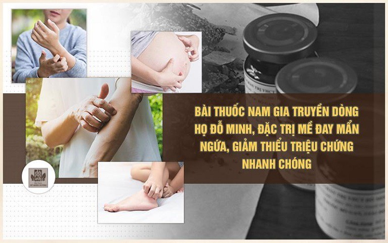 Bài thuốc gia truyền Đỗ Minh Đường là phương thuốc chữa nổi mề đay nổi tiếng và được nhiều chuyên gia đánh giá cao 