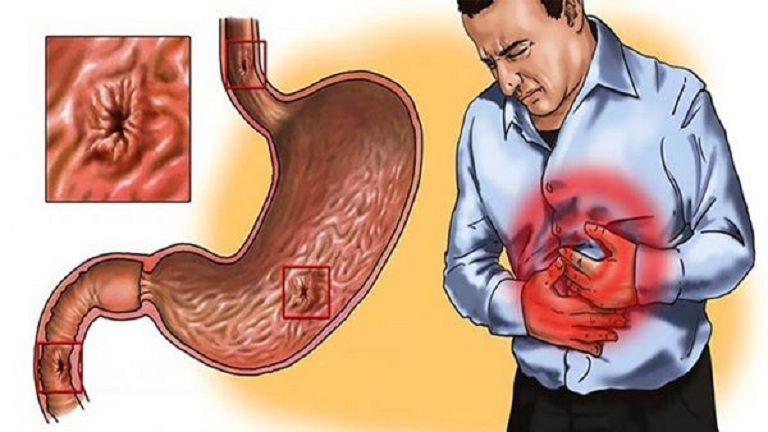 Đau bụng là triệu chứng của viêm niêm mạc dạ dày cấp tính