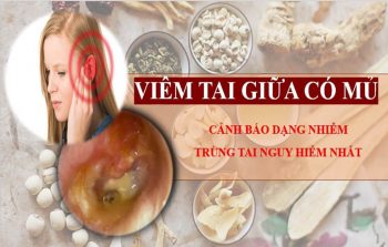 Viêm tai giữa có mủ