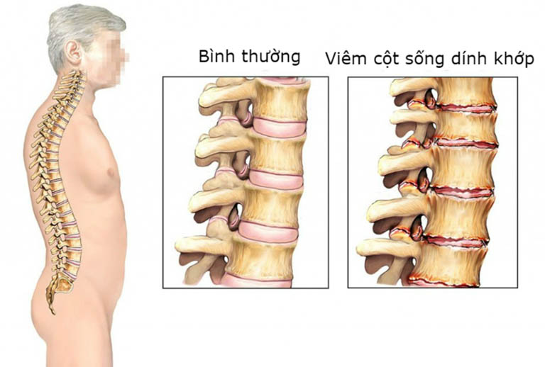 Viêm cột sống dính khớp: Nguyên nhân, Triệu chứng, cách điều trị