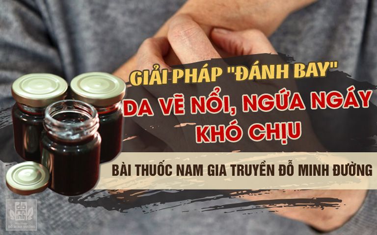 Bài thuốc chữa da vẽ nổi của Đỗ Minh Đường hiệu quả và an toàn, trị bệnh dứt điểm