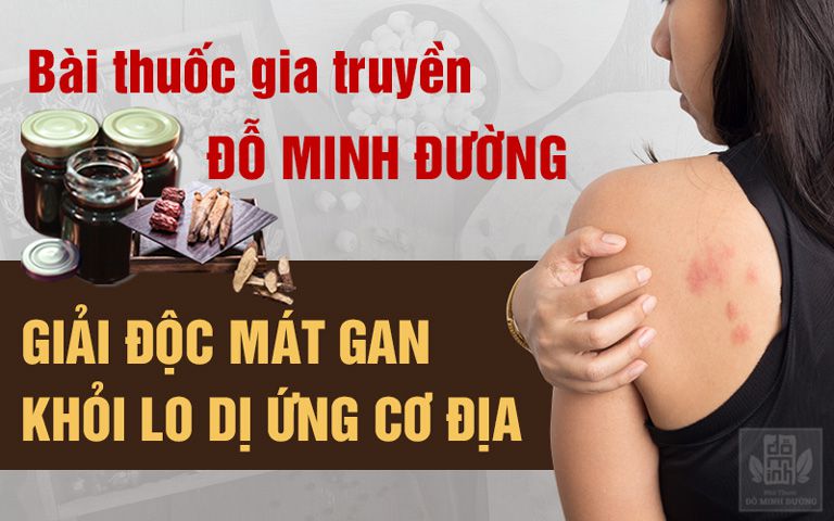 Bài thuốc chữa dị ứng cơ địa của Đỗ Minh Đường hiệu quả triệt để, không tái phát