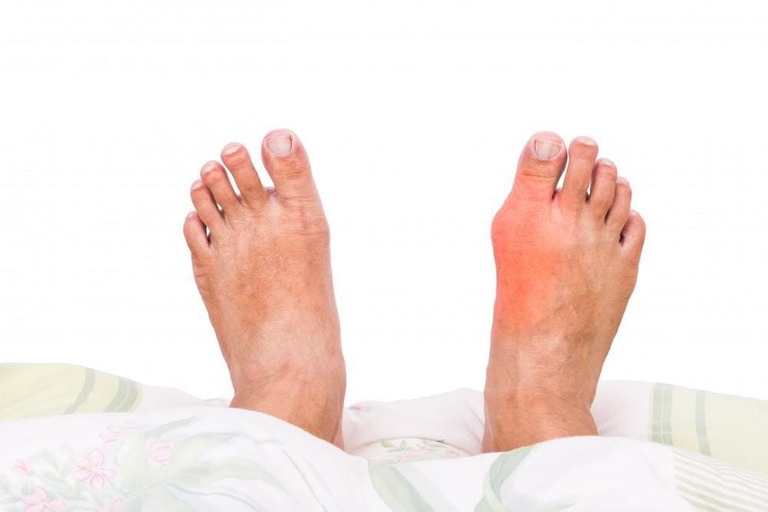 Biểu hiện bệnh gout cấp