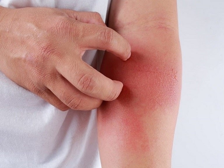 Chuyên gia mách bí quyết cách chữa dị ứng da tại nhà hiệu quả nhất