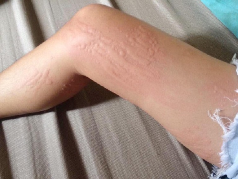 Dị ứng thời tiết có nguy hiểm không? Phải làm gì khi bị dị ứng?