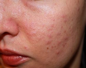Cách chữa dị ứng thời tiết tại nhà an toàn, hiệu quả