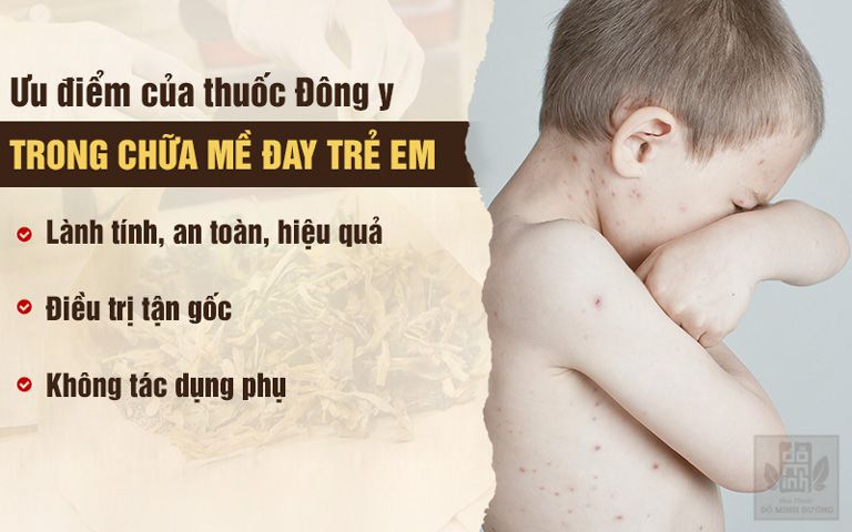 Thuốc Đông y giúp chữa nổi mề đay trẻ em từ gốc, hiệu quả lâu dài