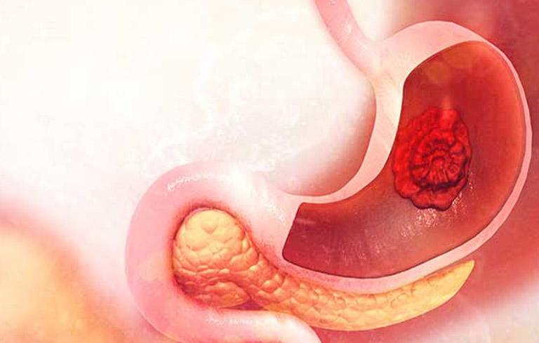 Viêm loét dạ dày gây ra những triệu chứng đau bụng, đi ngoài kèm đau đầu
