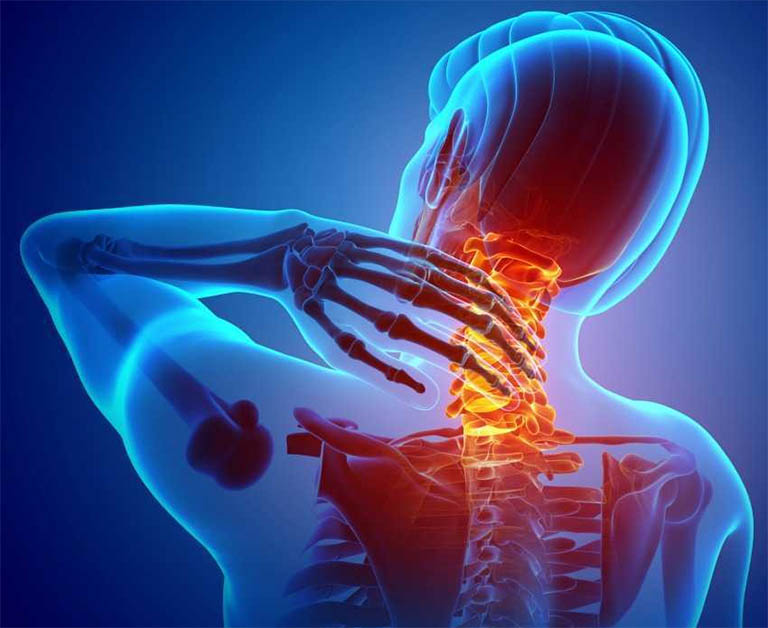 Hiện tượng đau xương cổ có thể là dấu hiệu của một bệnh lý xương khớp nguy hiểm