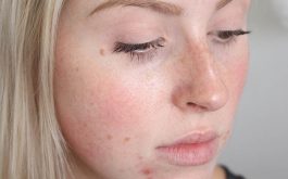 Dị ứng da mặt mẩn đỏ ngứa là gì và cách chữa hiệu quả cao
